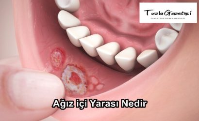 Ağız içi Yarası Nedir