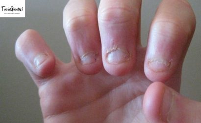 Tırnak Yemeyi Önlemek için 7 çözüm