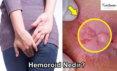 Hemoroid tedavisi Nedir?