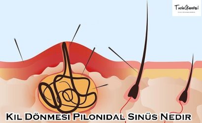 Kıl Dönmesi Pilonidal Sinüs Nedir