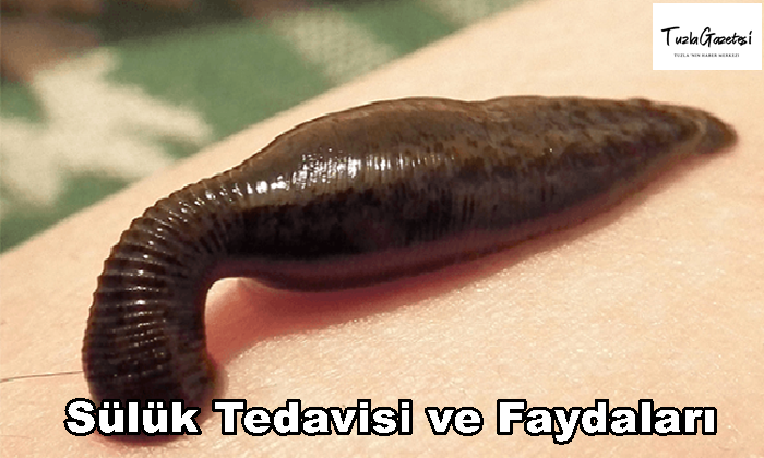 Sülük Tedavisi ve Faydaları