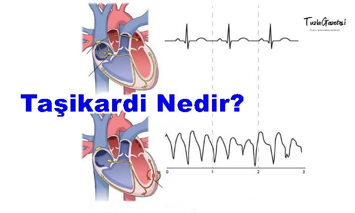 Taşikardi Nedir