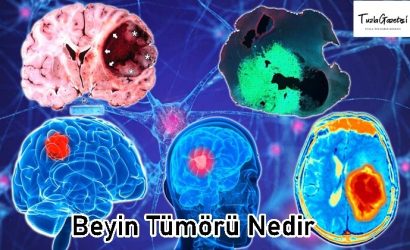 Beyin Tümörü tedavisi Nedir