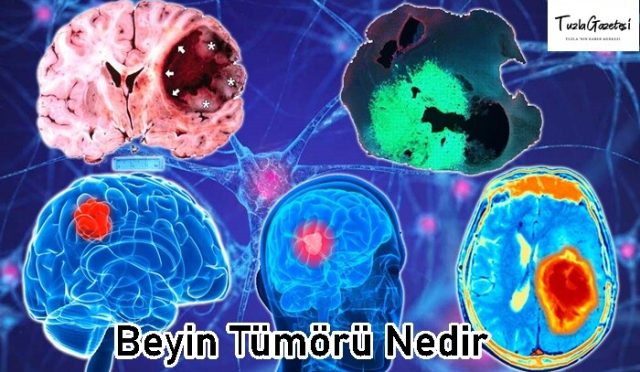 Beyin Tümörü tedavisi Nedir