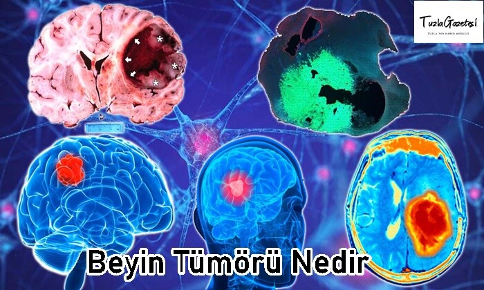 Beyin Tümörü Nedir