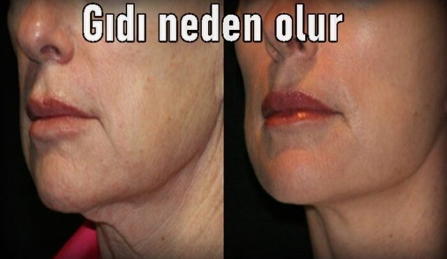 Gıdı neden olur tedavisi var mı