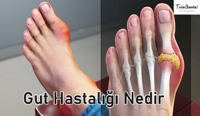 Gut Hastalığı tadavisi Nedir