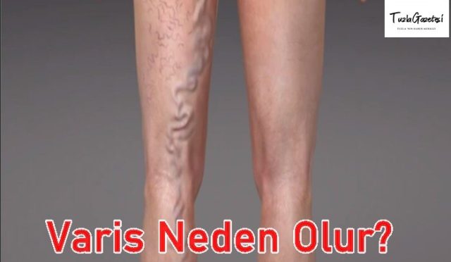 Varis Neden Olur tedavisi