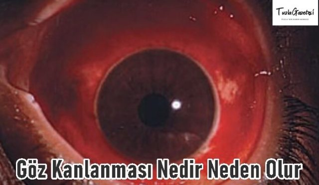Göz Kanlanması sebebi Nedir Neden Olur