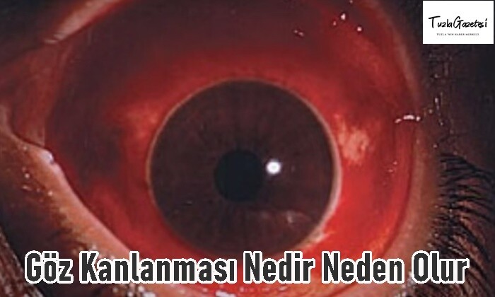 Göz Kanlanması Nedir Neden Olur