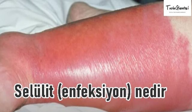 Selülit (enfeksiyon) nedir tedavisi