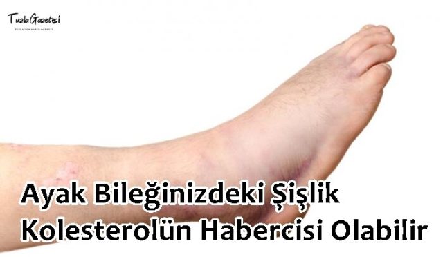 Ayak Bileğinizdeki Şişlik Kolesterolün Habercisi Olabilir