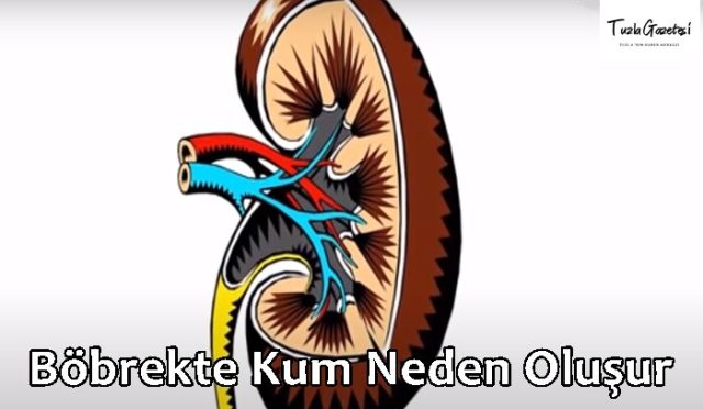 Böbrekte Kum Neden Oluşur 