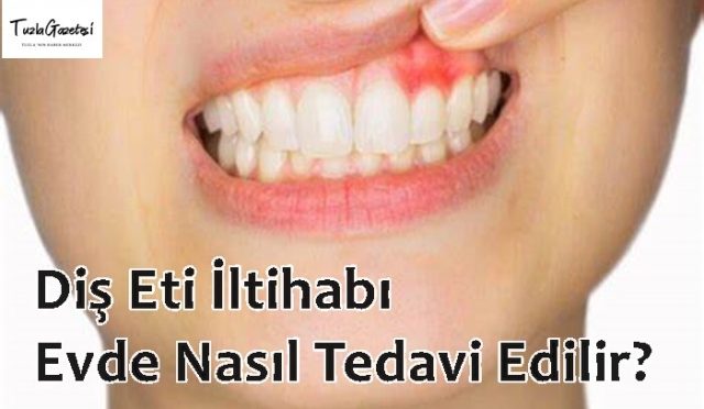 doğal yöntemler ile Diş Eti İltihabı Evde Nasıl Tedavi Edilir