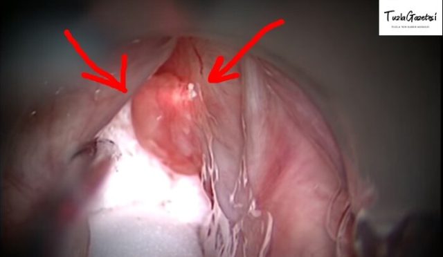 Gırtlak Kanseri Nedir