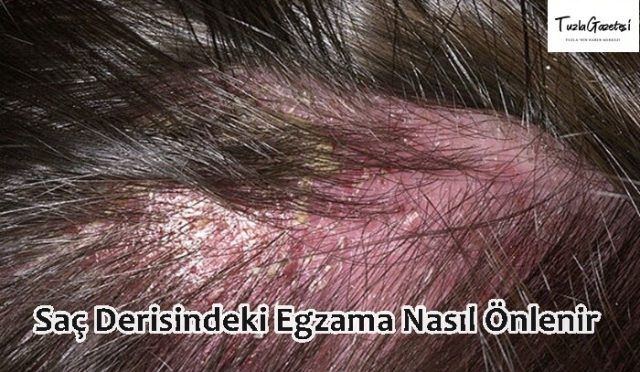 Saç Derisindeki Egzama Nasıl Önlenir