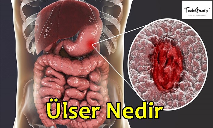 Ülser belirtileri Nedir