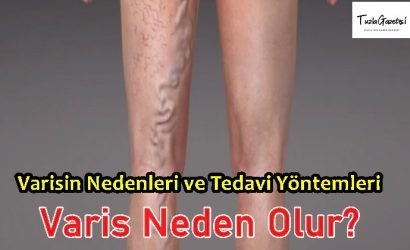 Varisin Nedenleri ve Tedavi Yöntemleri