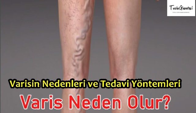 Varisin Nedenleri ve Tedavi Yöntemleri