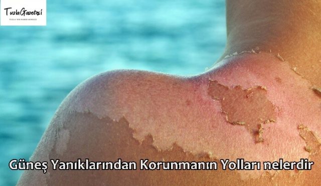Güneş Yanıklarından Korunmanın Yolları nelerdir