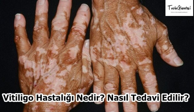 Vitiligo Hastalığı Nedir Nasıl Tedavi Edilir