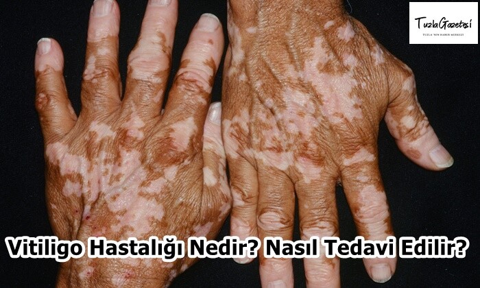 Vitiligo Hastalığı Nedir Nasıl Tedavi Edilir