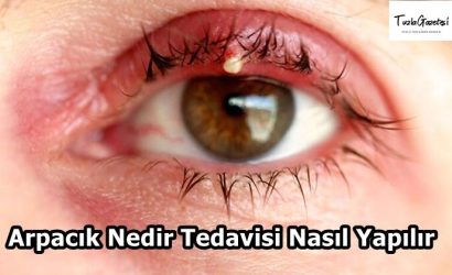 Arpacık Nedir Tedavisi Nasıl Yapılır