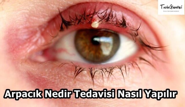 Arpacık Nedir Tedavisi Nasıl Yapılır