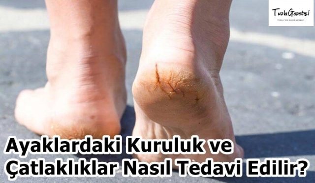 Ayaklardaki Kuruluk ve Çatlaklıklar Nasıl Tedavi Edilir
