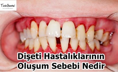 Dişeti Hastalıklarının Oluşum Sebebi Nedir