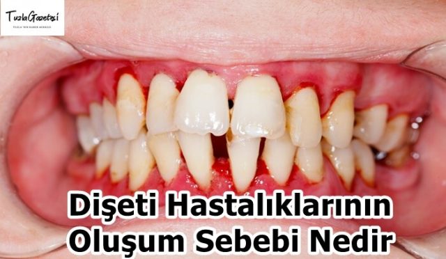 Dişeti Hastalıklarının Oluşum Sebebi Nedir