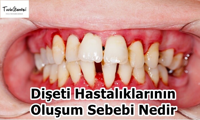 Dişeti Hastalıklarının Oluşum Sebebi Nedir