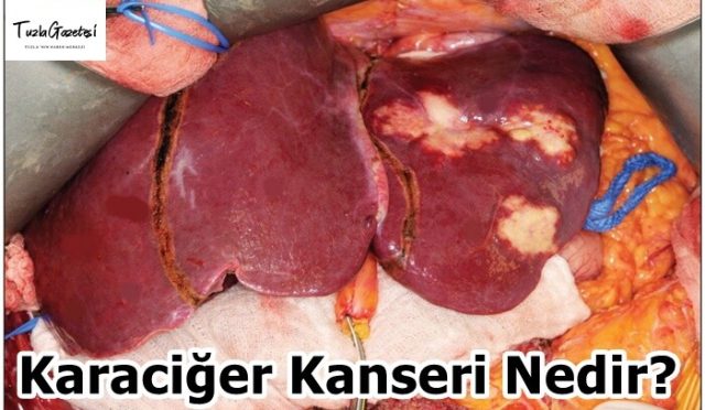 Karaciğer Kanseri Nedir?