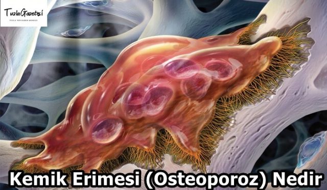 Kemik Erimesi (Osteoporoz) Nedir
