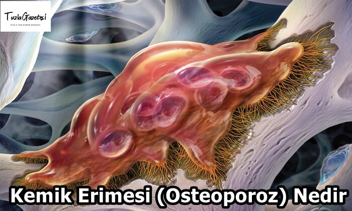 Kemik Erimesi (Osteoporoz) Nedir