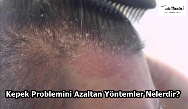 Kepek Problemini Azaltan Yöntemler Nelerdir