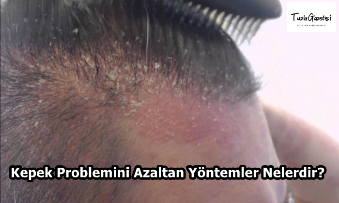 Kepek Problemini Azaltan Yöntemler Nelerdir