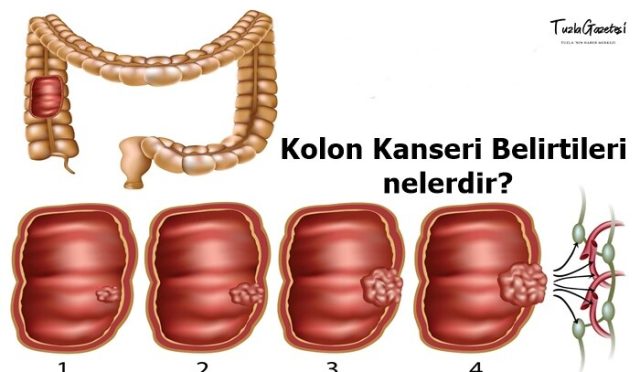 Kolon Kanseri Belirtileri nedir