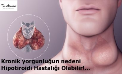 Kronik yorgunluğun nedeni Hipotiroidi Hastalığı Olabilir