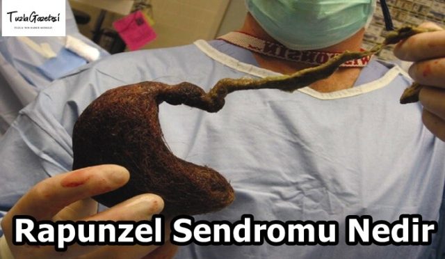 Rapunzel Sendromu nedenleri Nedir