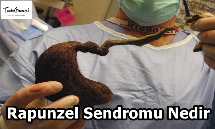 Rapunzel Sendromu nedenleri Nedir