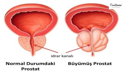 Antidepresan Kullanmak Prostat Kanserinin İlerleyişini Durduruyor Mu