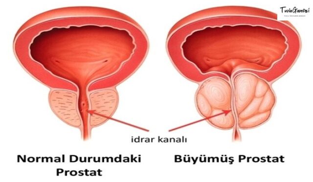 Antidepresan Kullanmak Prostat Kanserinin İlerleyişini Durduruyor Mu