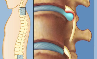 Boyun Fıtığı Nasıl Oluşur