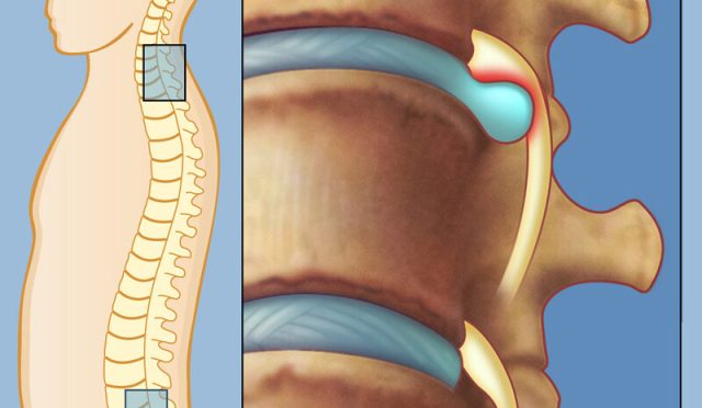 Boyun Fıtığı Nasıl Oluşur