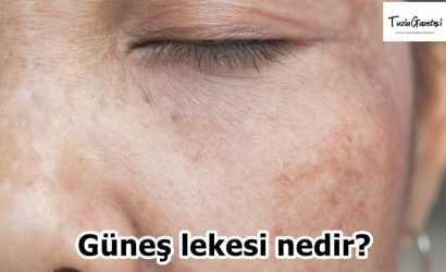 Güneş lekesi nedir tuzlada