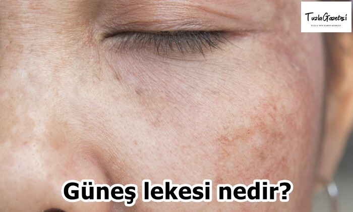 Güneş lekesi nedir?