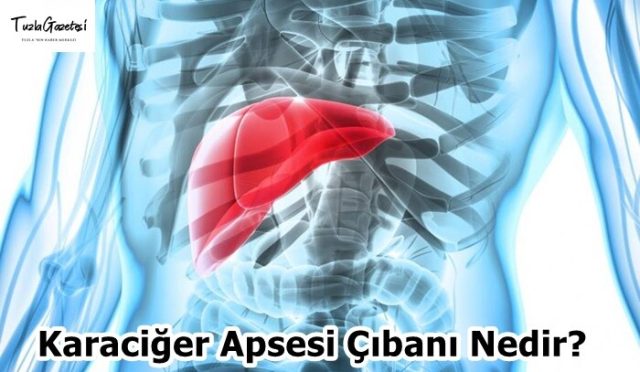 Karaciğer Apsesi Çıbanı Nedir
