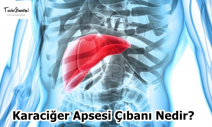 Karaciğer Apsesi Çıbanı Nedir