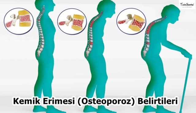 Kemik Erimesi (Osteoporoz) Belirtileri